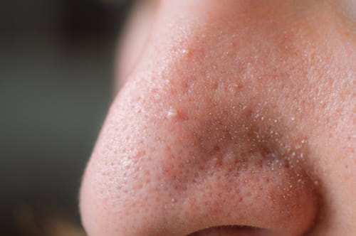 Close up of nose with clogged pores