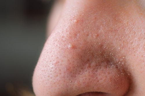 Close up of nose with acne