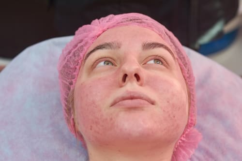 Young woman with acne rosacea lying on bed