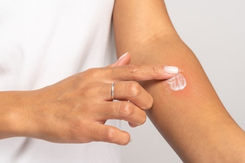 Arm skin reacting to calamine lotion