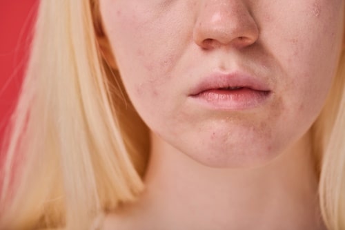 Lower view of bad skin on face