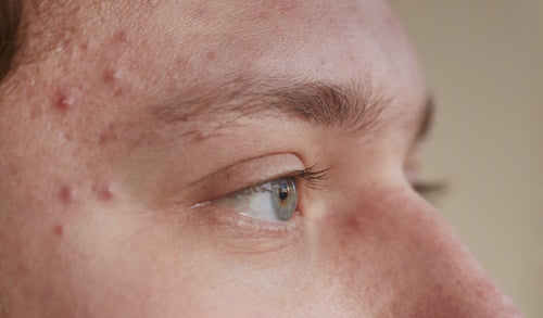 Acne in a persons forehead