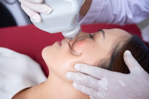 Woman getting laser resurfacing acne treatment in clinic