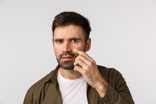 Man frustrated with hair loss and acne