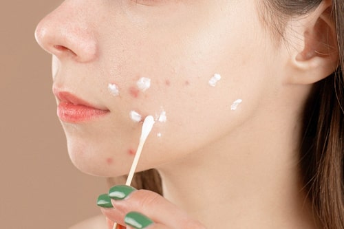 Young woman applying mupirocin on face acnes