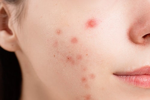 Woman who has severe acne close up