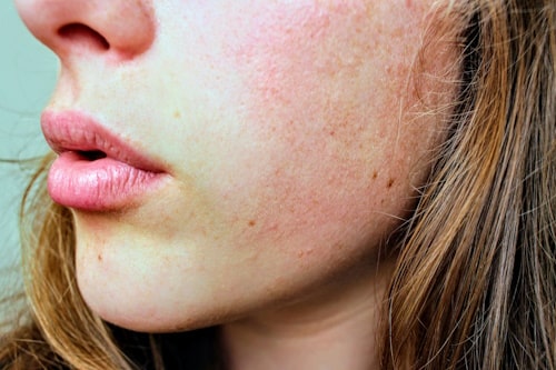 Dry skin due to over use of vitamin c serum