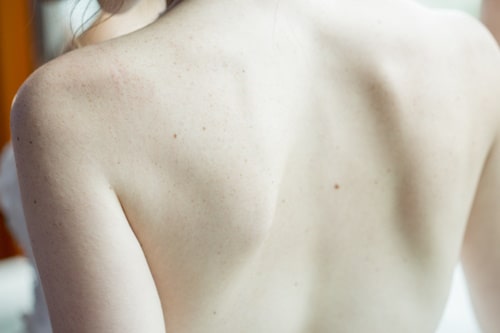 A woman's back with back acne