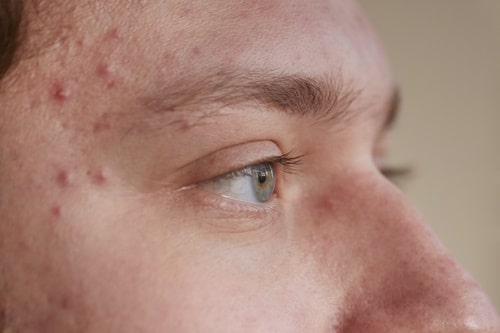 Person with inflammed pores