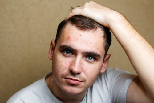 Man pulling hair up to show large pimple