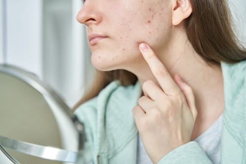Image of woman checking the acne on her face