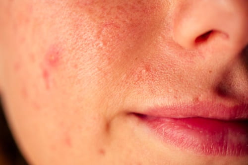 Face with acne and contact dermatitis