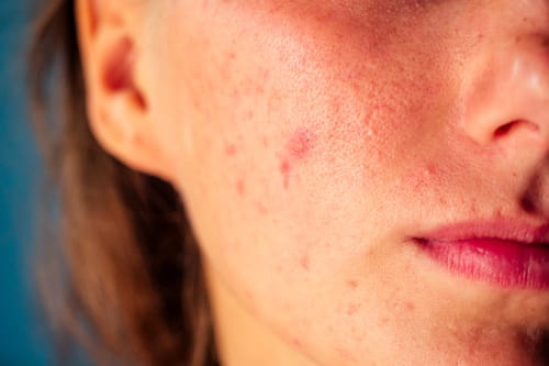 Close up of face of woman with red acne on face