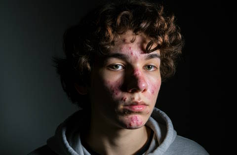 young man with severe acne