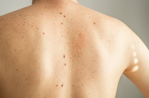 Back of a person filled with back acne