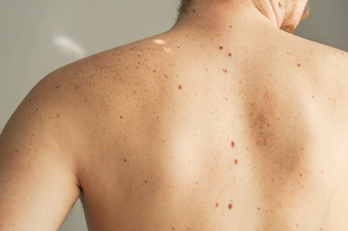 Skin on a man back with scattered acne