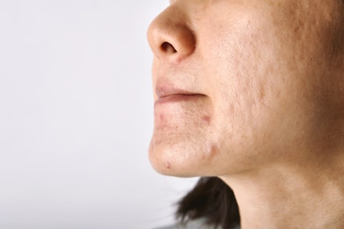 Close up of woman's face with acne scars