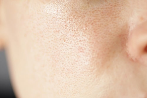 Skin texture unhealthy with with enlarged pores