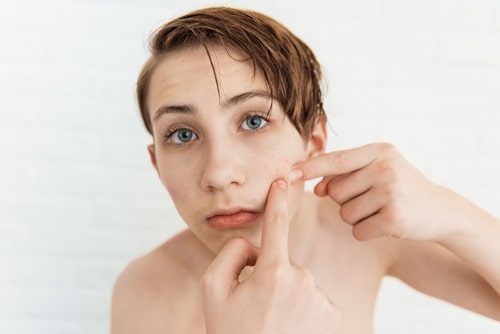 Teenage boy popping hormonal acne