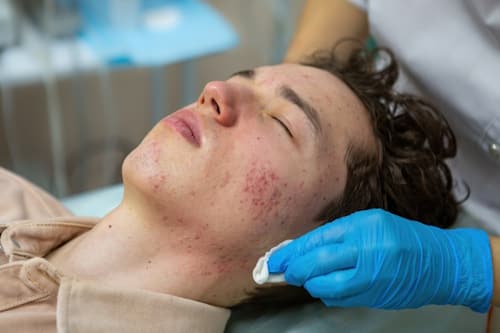 Young man lying on medical bed with severe acne