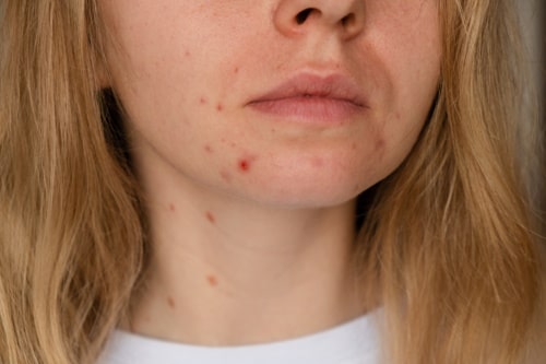Unrecognizable woman showing her acne on face