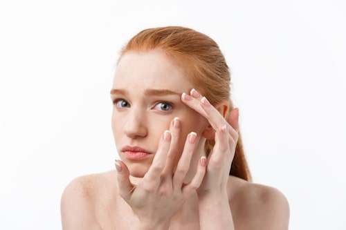 Young woman having acne breakout
