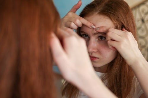 Teen undergoing hormonal changes that result in acne