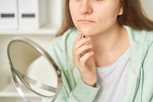 Young teenage female with acne looking at mirror