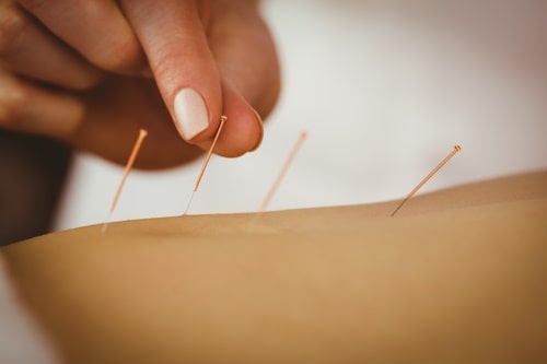 Close up of woman getting acupuncture