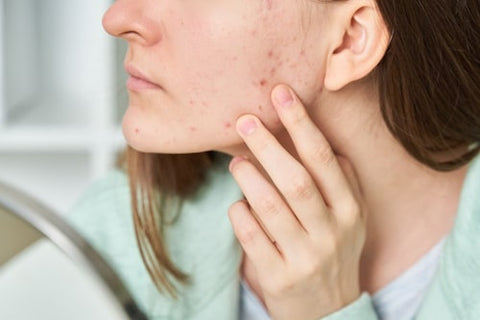 Zoom up of face of woman with worsening acne