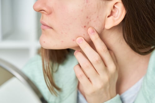 Close up of woman with acne due to dehydration