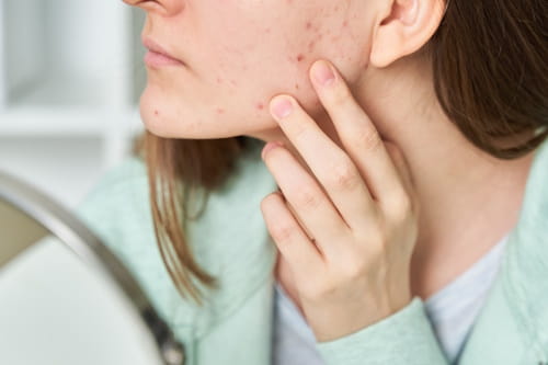 Woman looking at severe acne with mirror