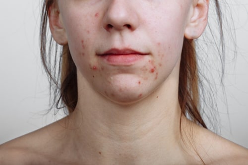 Woman with clusters of acne all over her face