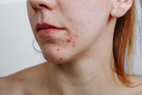 Woman with red bumps of acne on her face