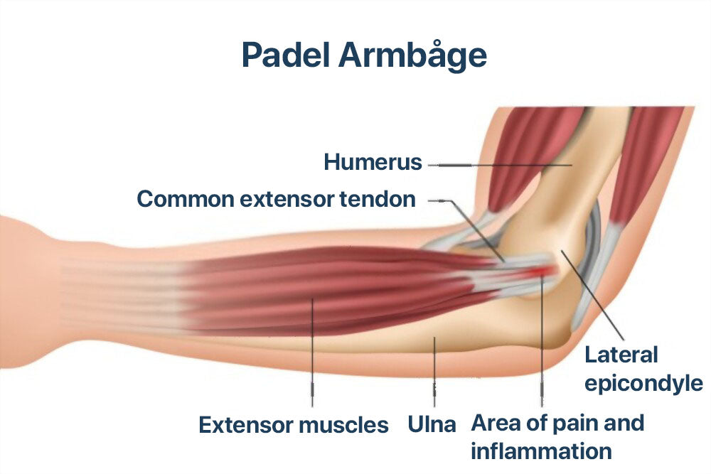Vad är padelarmbåge och en översikt av kroppen för att identifiera problemen