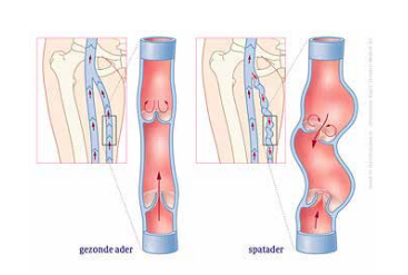 tekening goede ader en spatader compressiekousen nodig