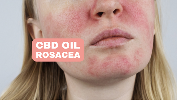 CBD-Öl gegen Rosacea, das gereizte Haut beruhigt