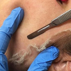 Dermaplaning Koteletten