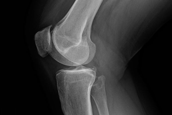 Visual addressing overuse and strain as key factors in managing and preventing knee discomfort.