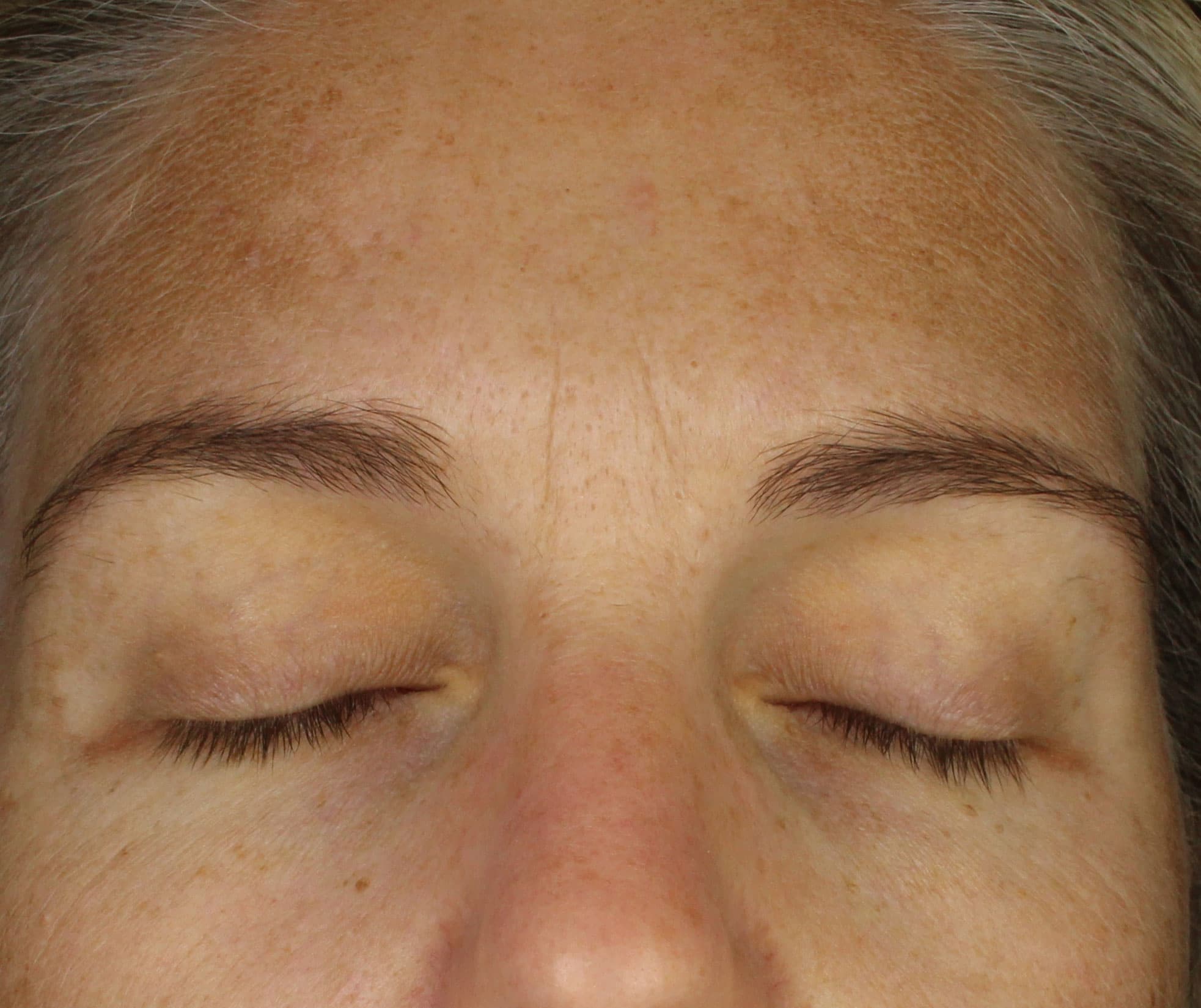 Retinol Skin Booster Before