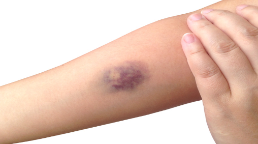 bruises in arm