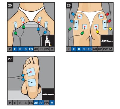 Electrode Placement for Electric Stimulation Charts