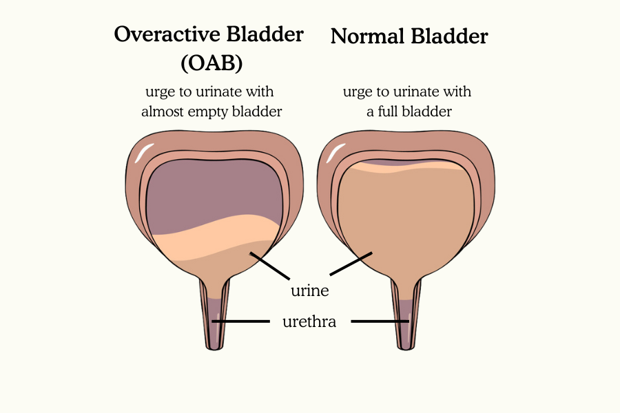Electrical stimulation for overactive bladder (OAB)