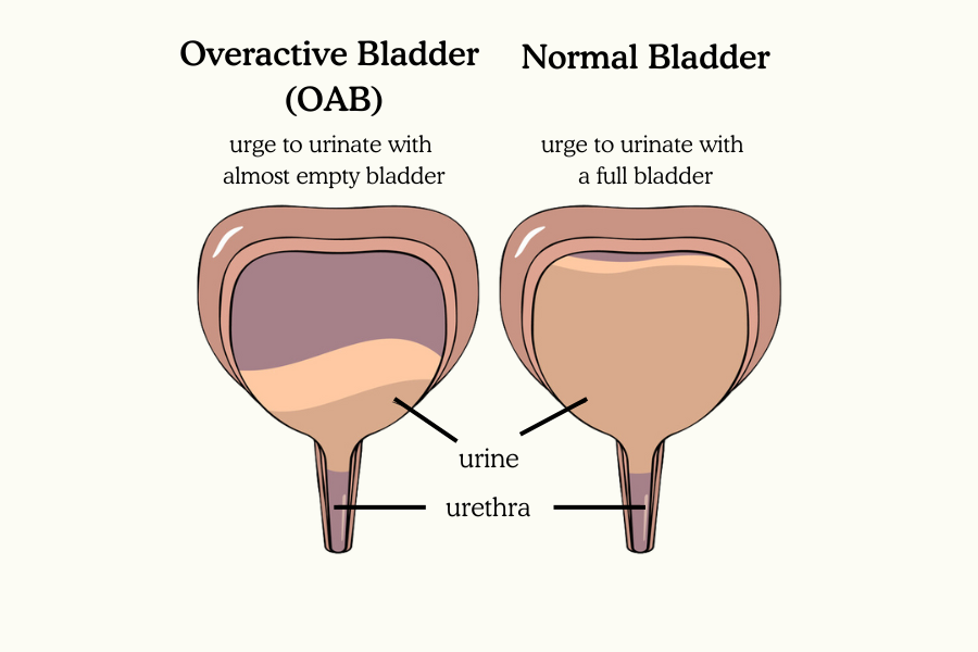 A graphic that shows the bladder with OAB and in normal circumstances.