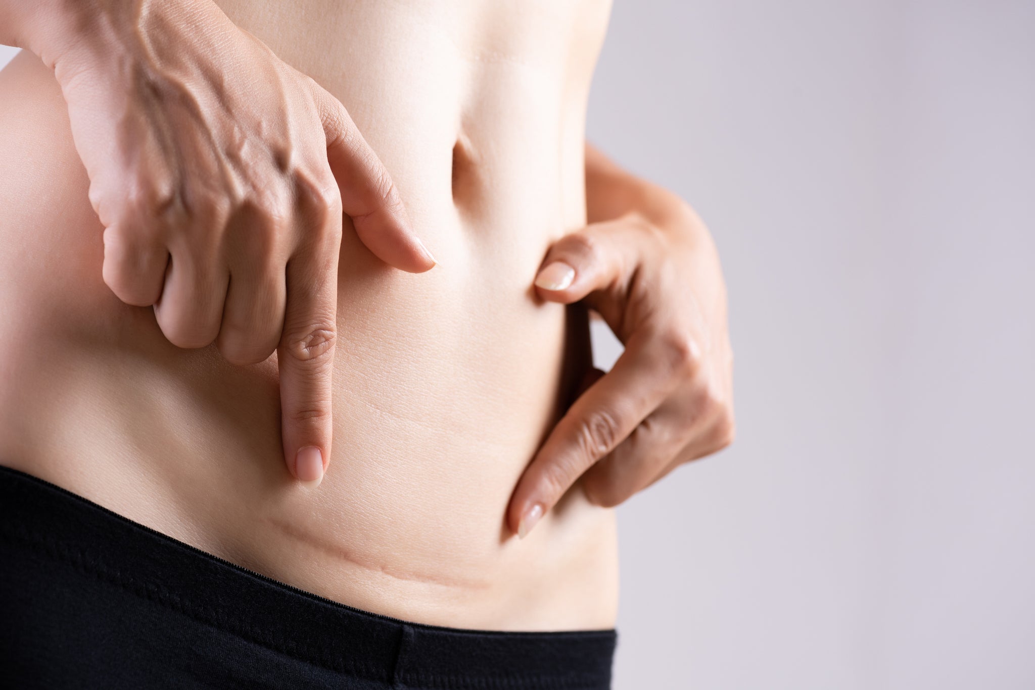 A person points to a surgical incision on their stomach.