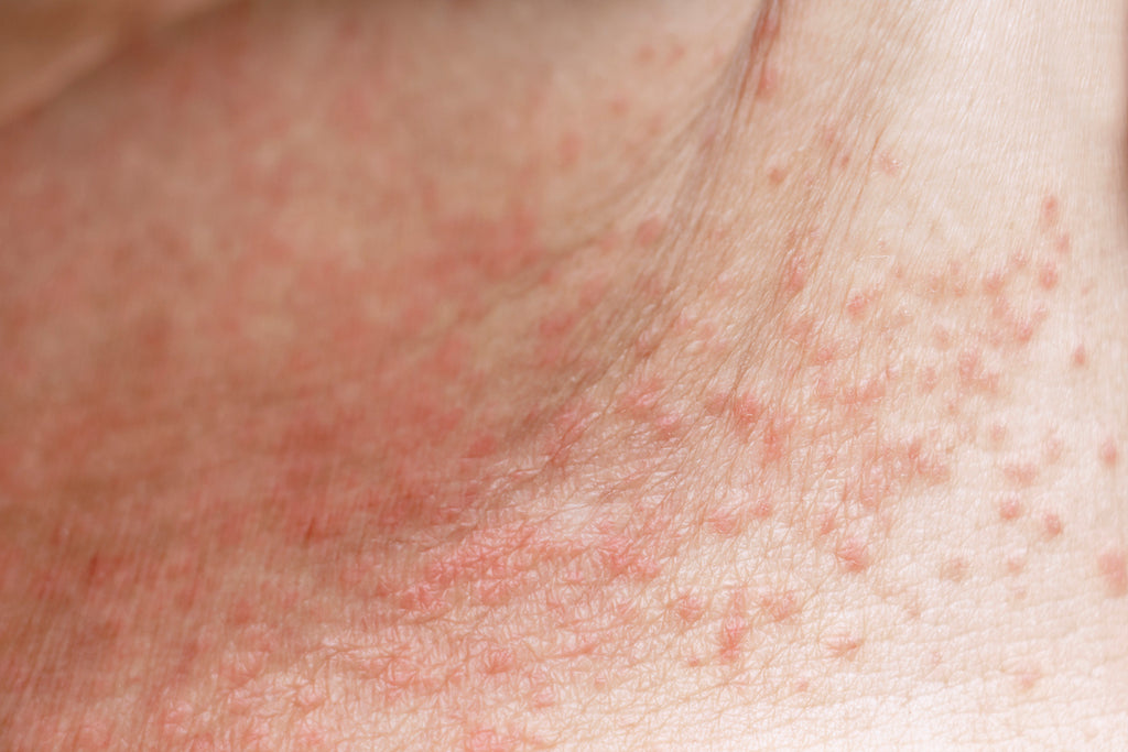 A close up of a rash on skin.