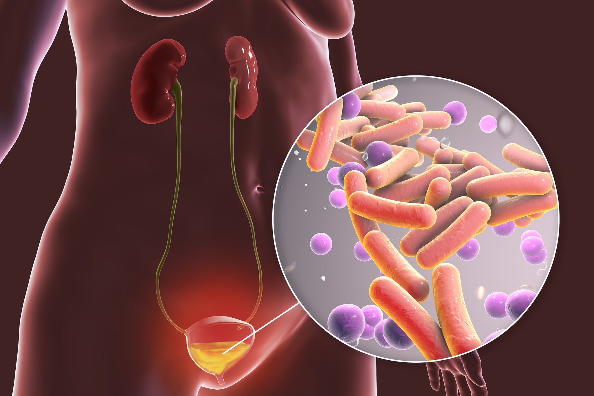 A graphic showing bacteria in the bladder.