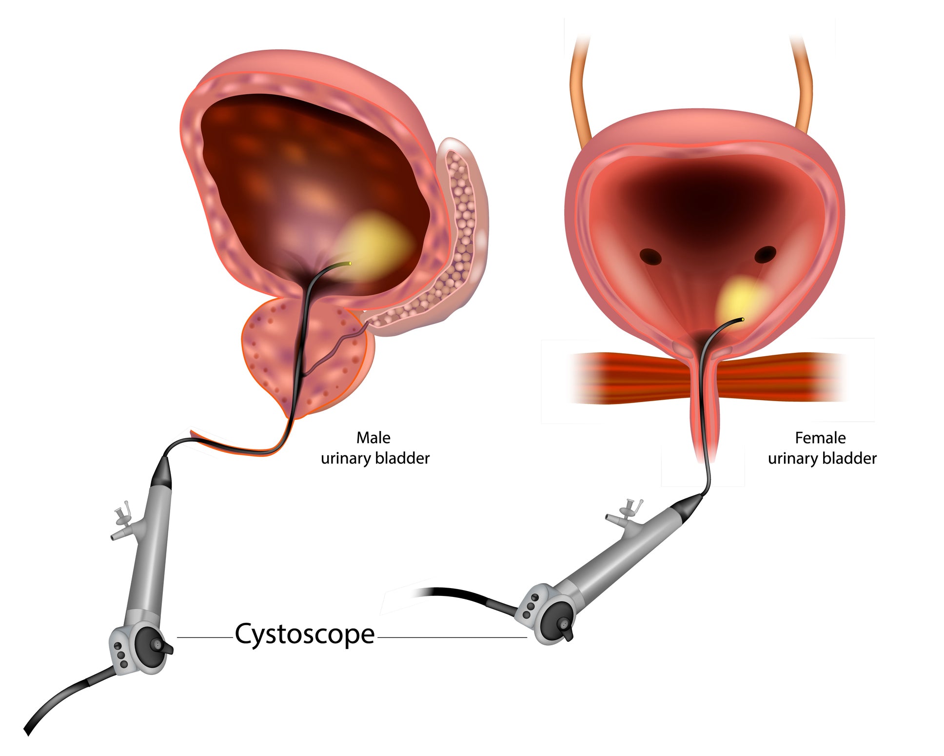 Graphical images of a cystoscopy.