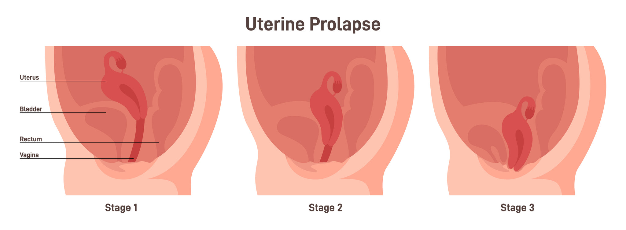 A graphic showing the stages of uterine prolapse.