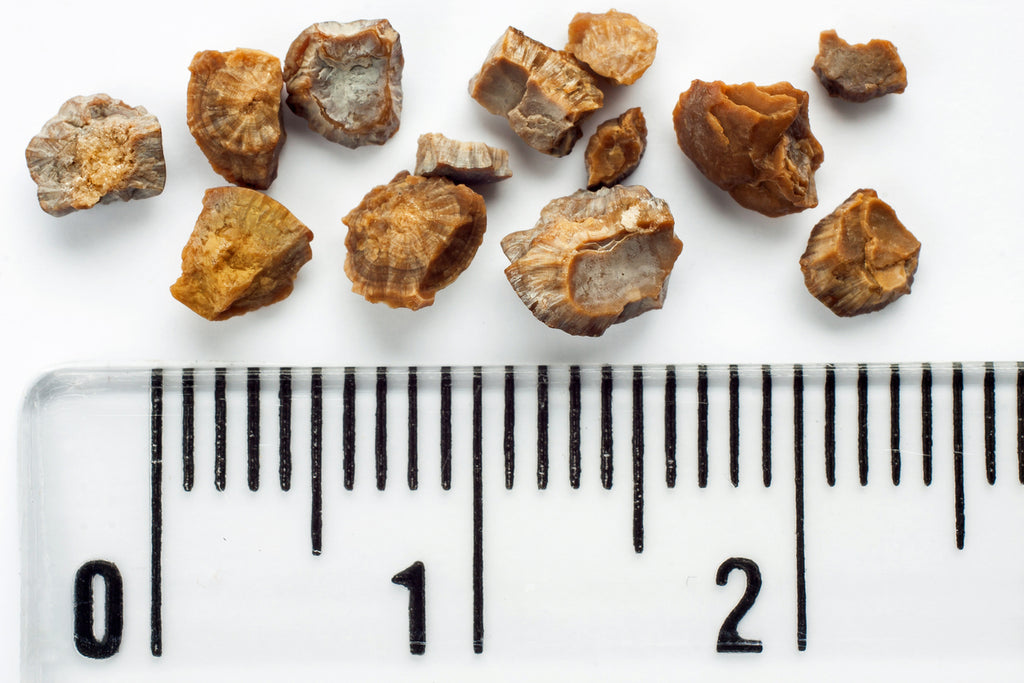 Kidney stones on a white background with a clear ruler to represent the size.